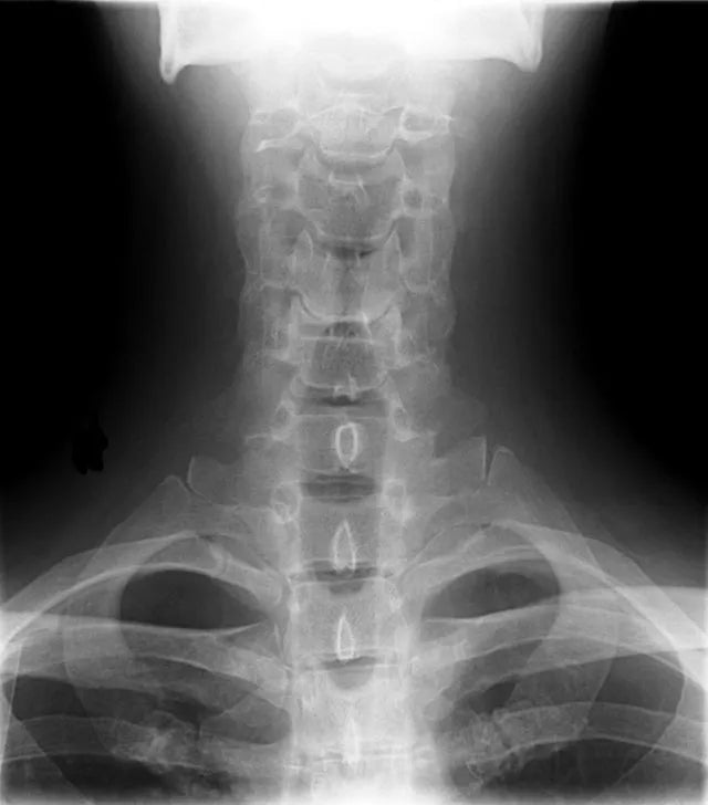 Cervical spine X-ray highlighting the neck and upper back region, often affected by musculoskeletal pain, stiffness, and joint disorders.