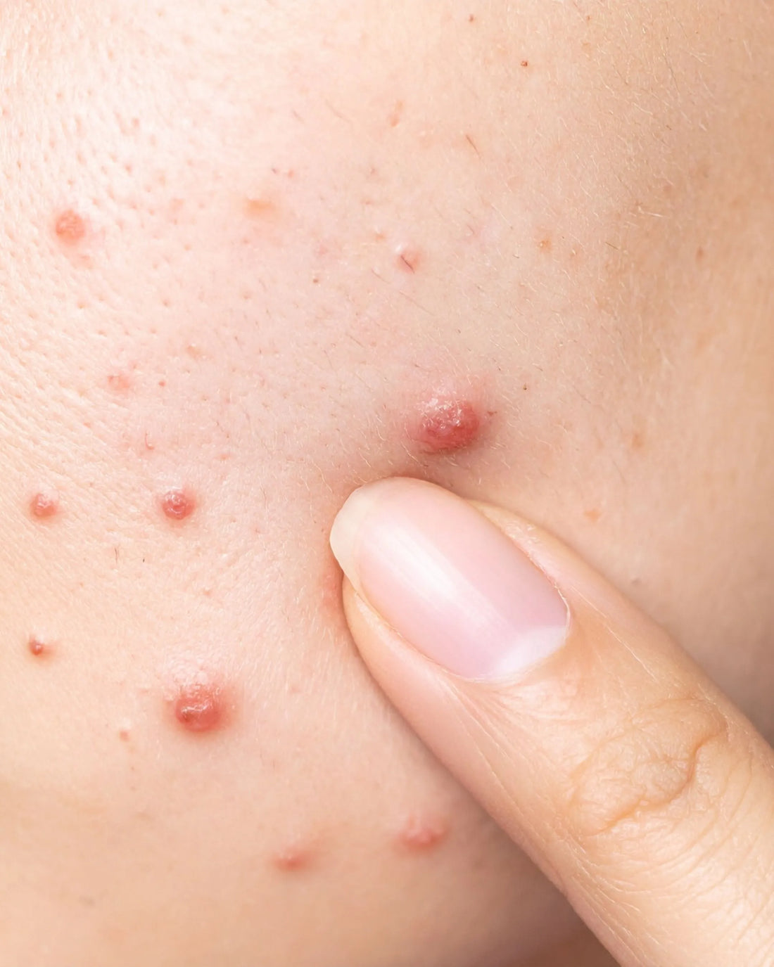 Why Blood Purification is the Real Secret to Radiant Skin | SKINESSA