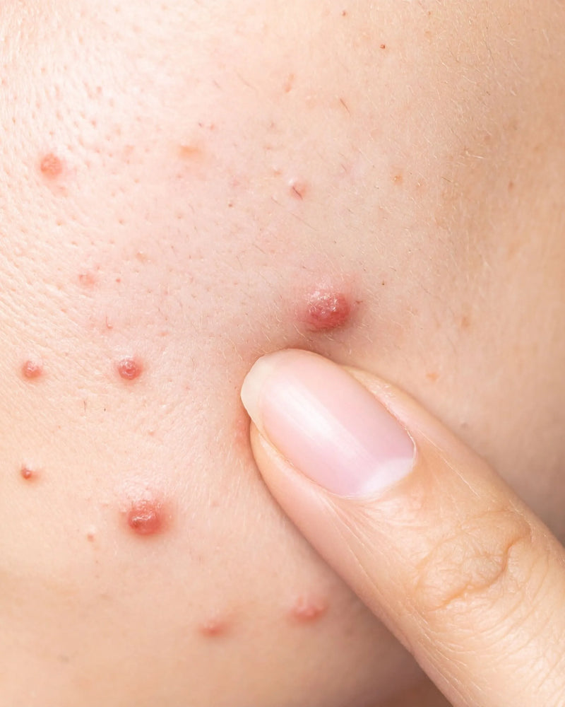 Why Blood Purification is the Real Secret to Radiant Skin | SKINESSA